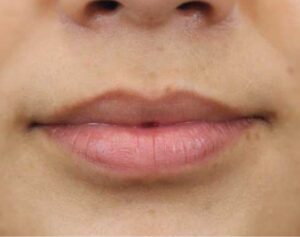Dermal Fillers