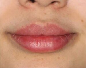 Dermal Fillers