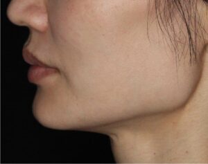 Dermal Fillers