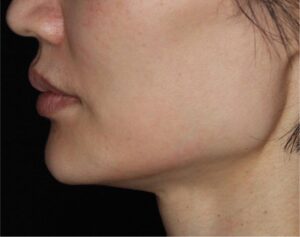 Dermal Fillers