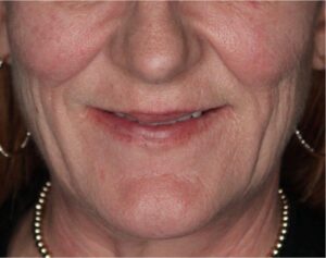 Dermal Fillers