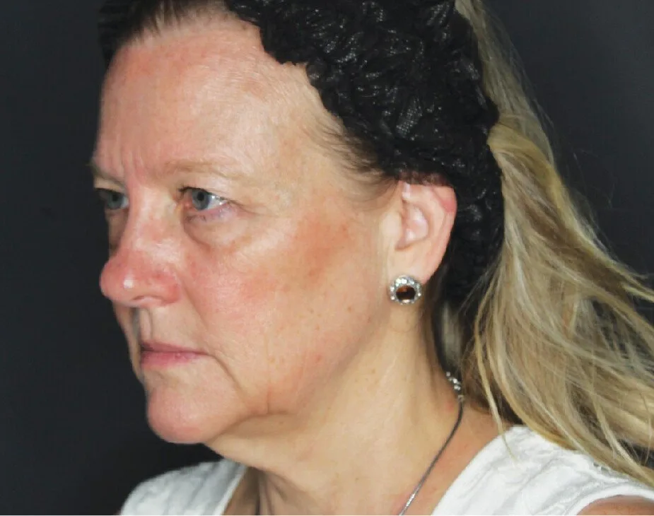 Facelift & Neck Lift