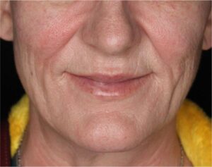Dermal Fillers