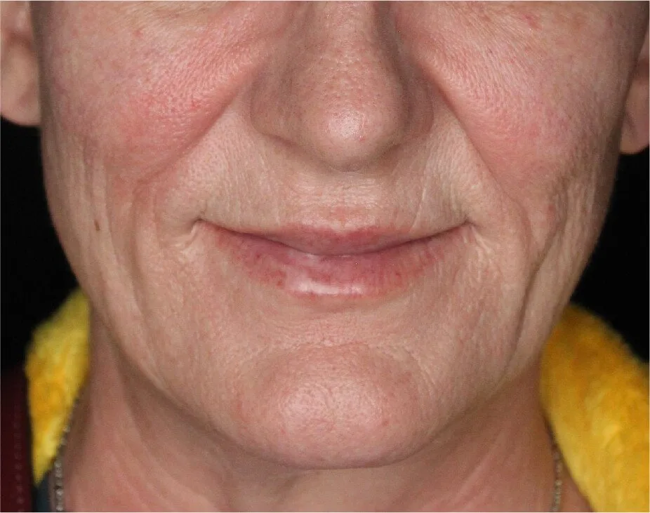 Dermal Fillers