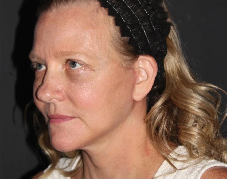 Facelift & Neck Lift