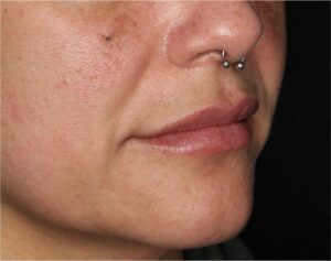 Dermal Fillers