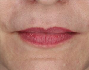 Lip Lift