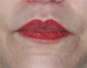 Lip Lift