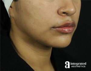 Lip Lift