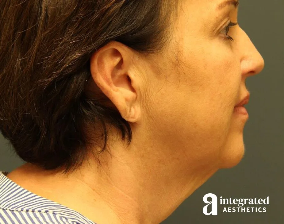 Facelift & Neck Lift
