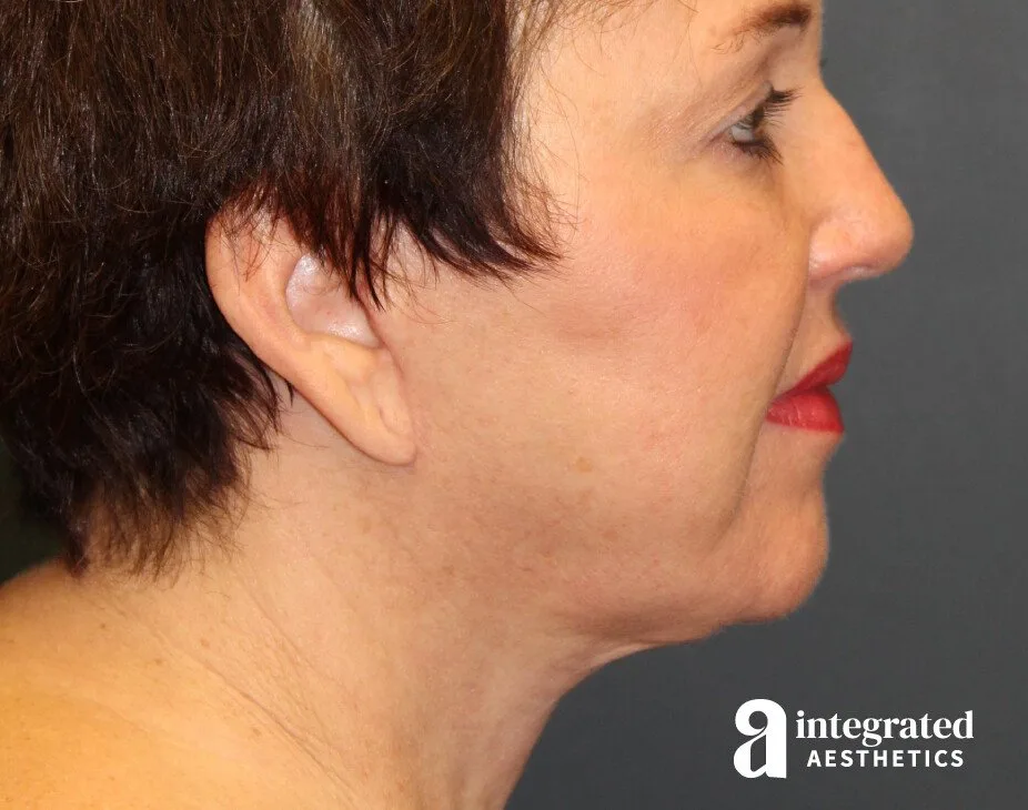 Facelift & Neck Lift