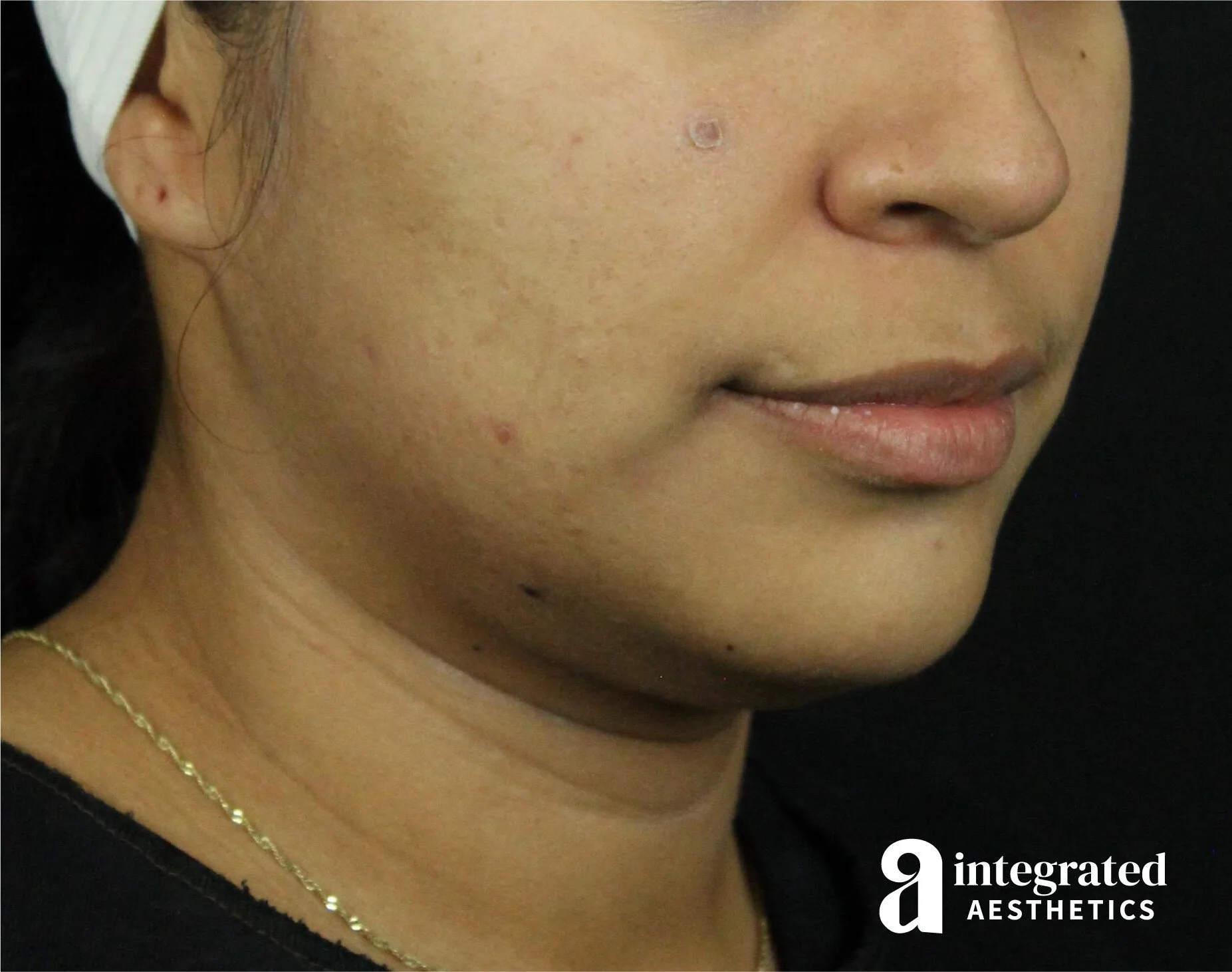 FaceTite & AccuTite