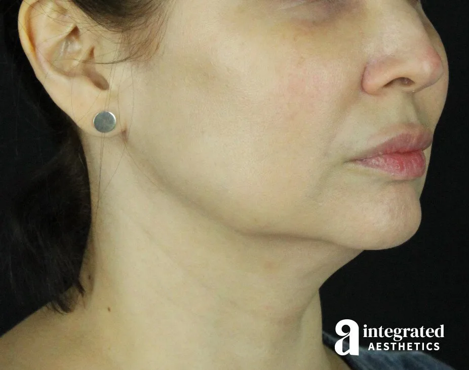 FaceTite & AccuTite