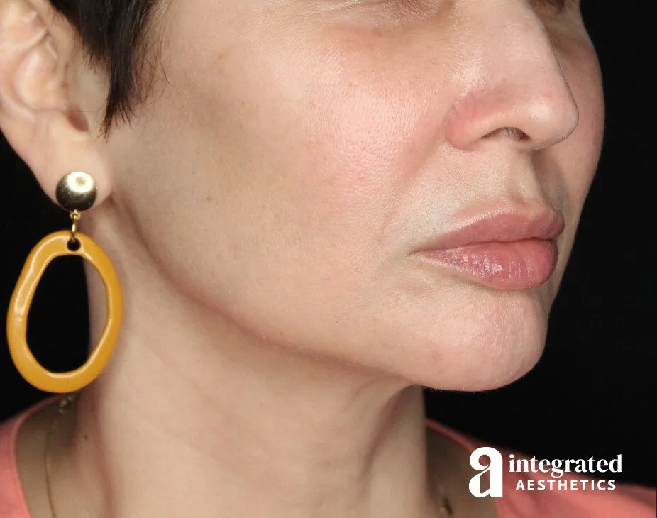 FaceTite & AccuTite