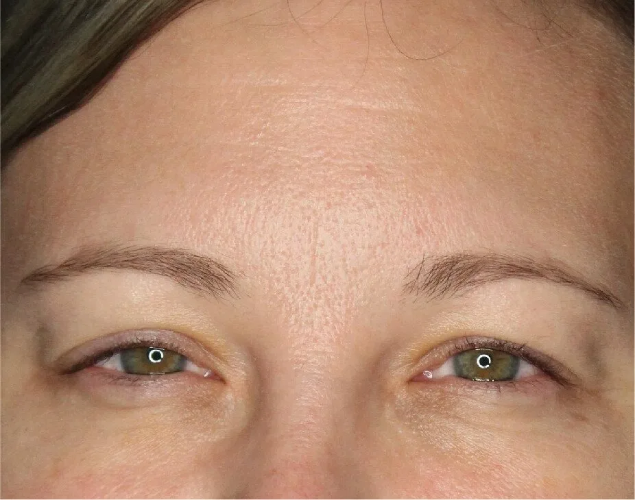 Wrinkle Relaxers