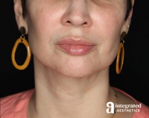 Dermal Fillers