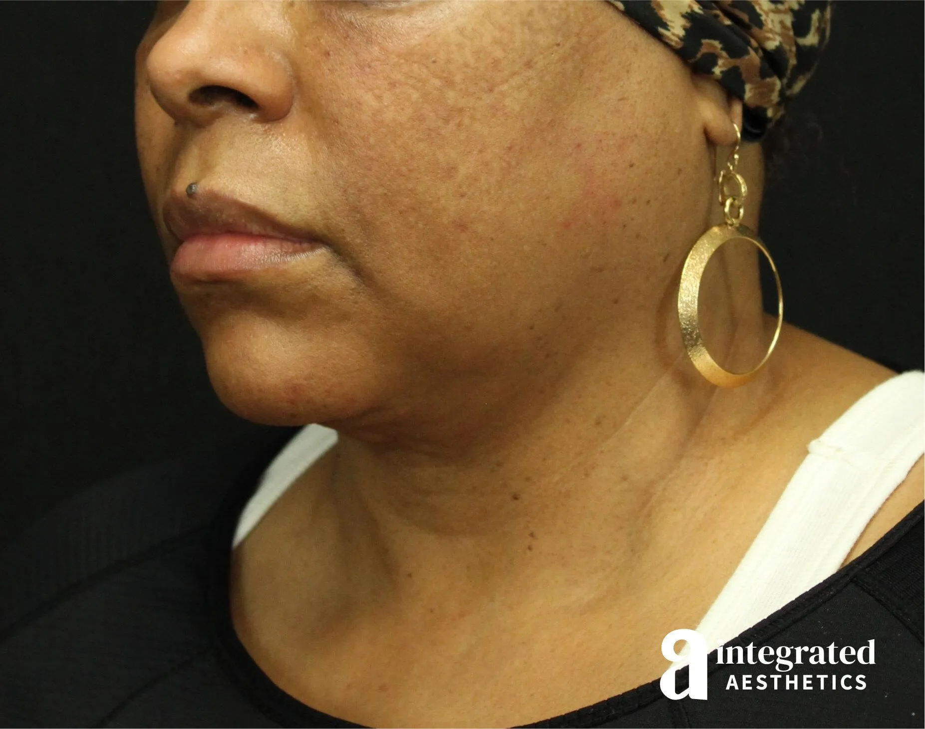 FaceTite & AccuTite