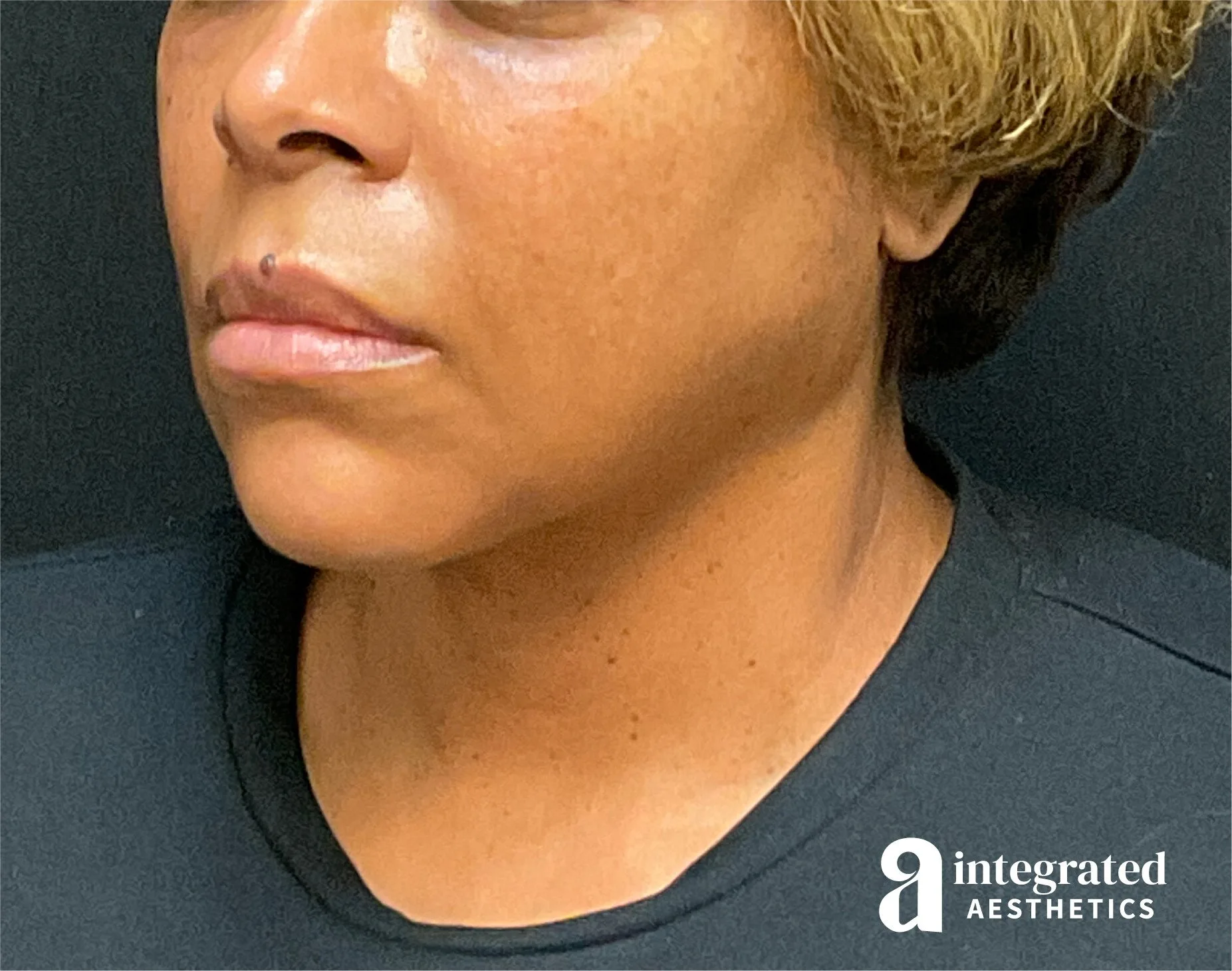 FaceTite & AccuTite