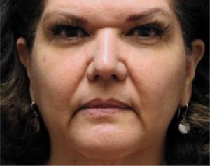 Dermal Fillers