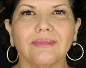 Dermal Fillers