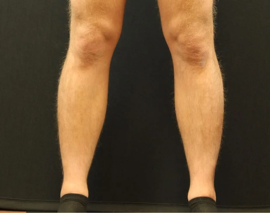 Calf Sculpting