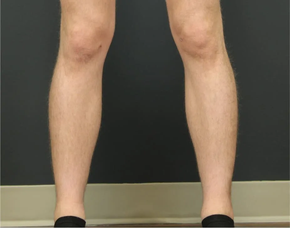 Calf Sculpting