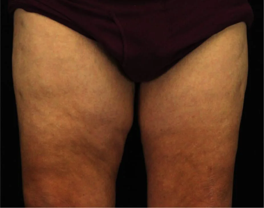 Thigh Lift