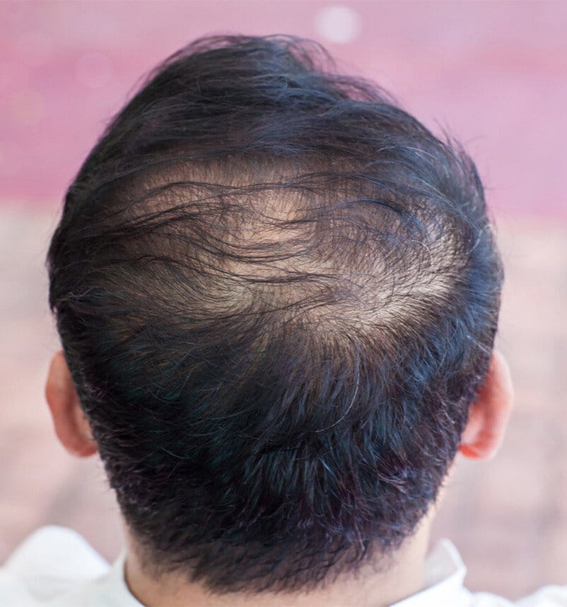 man with hair loss