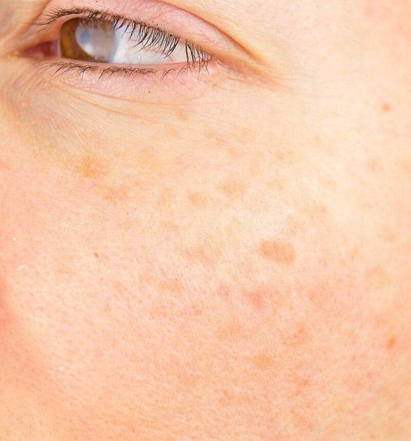 spots on face