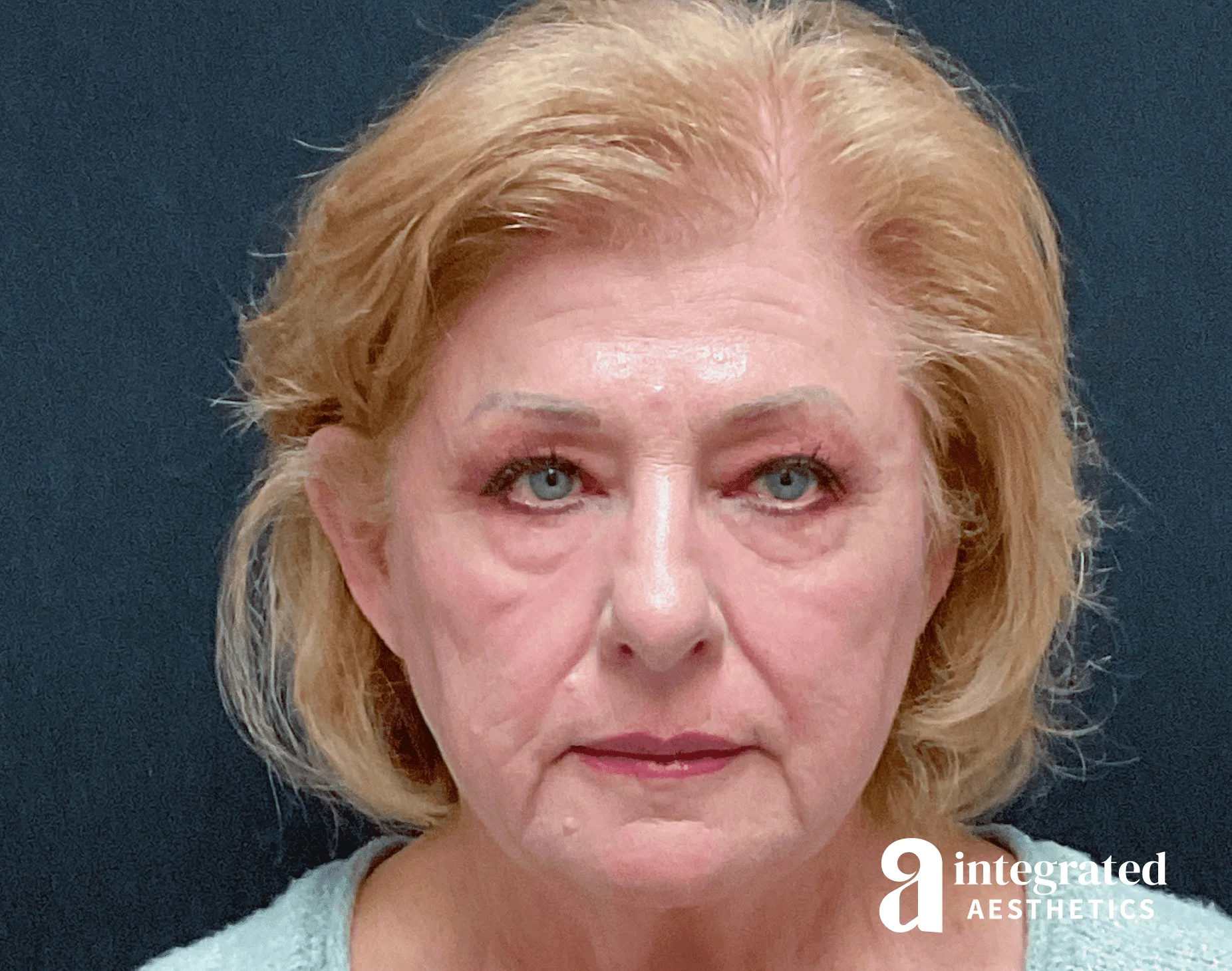 Blepharoplasty