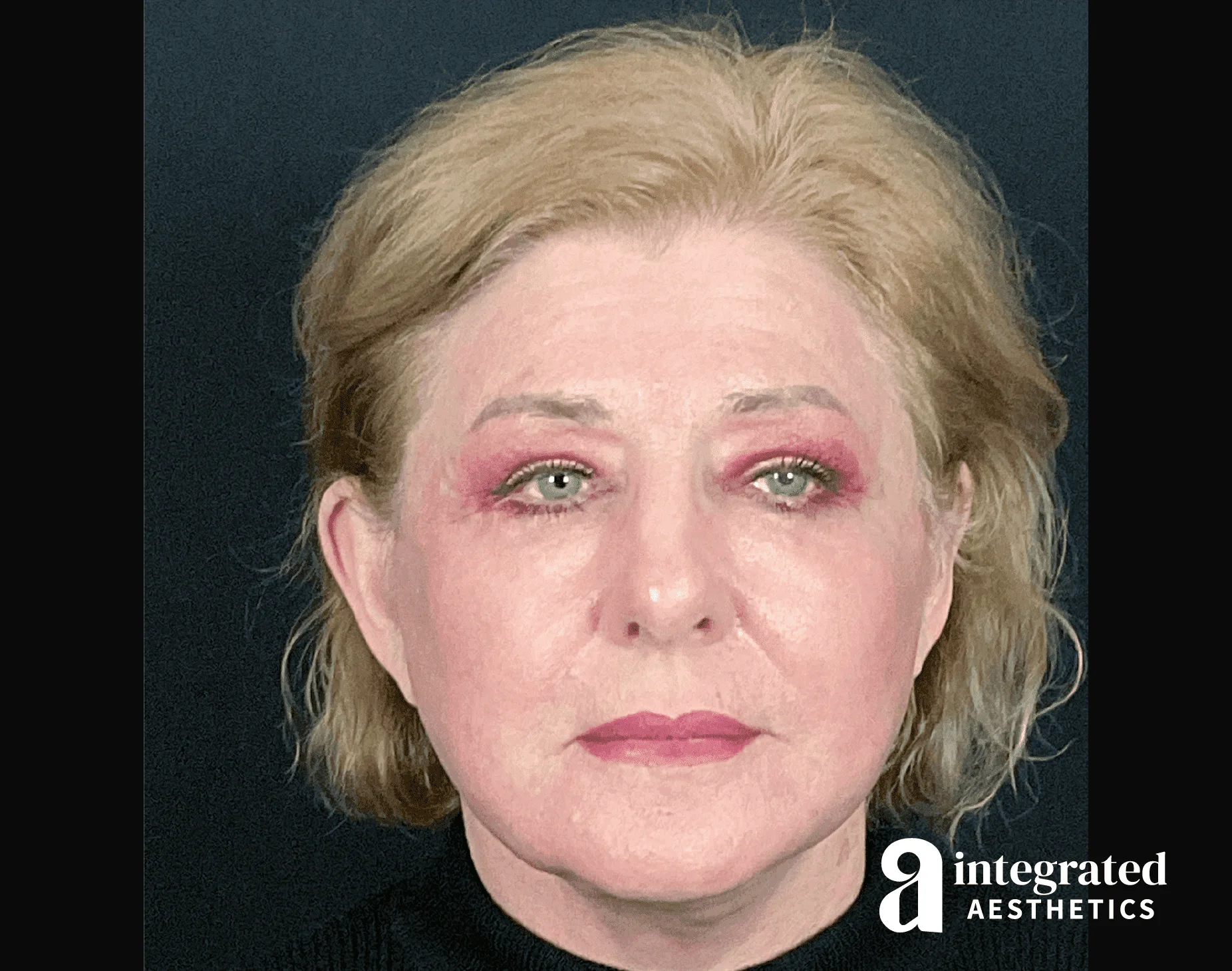 Blepharoplasty
