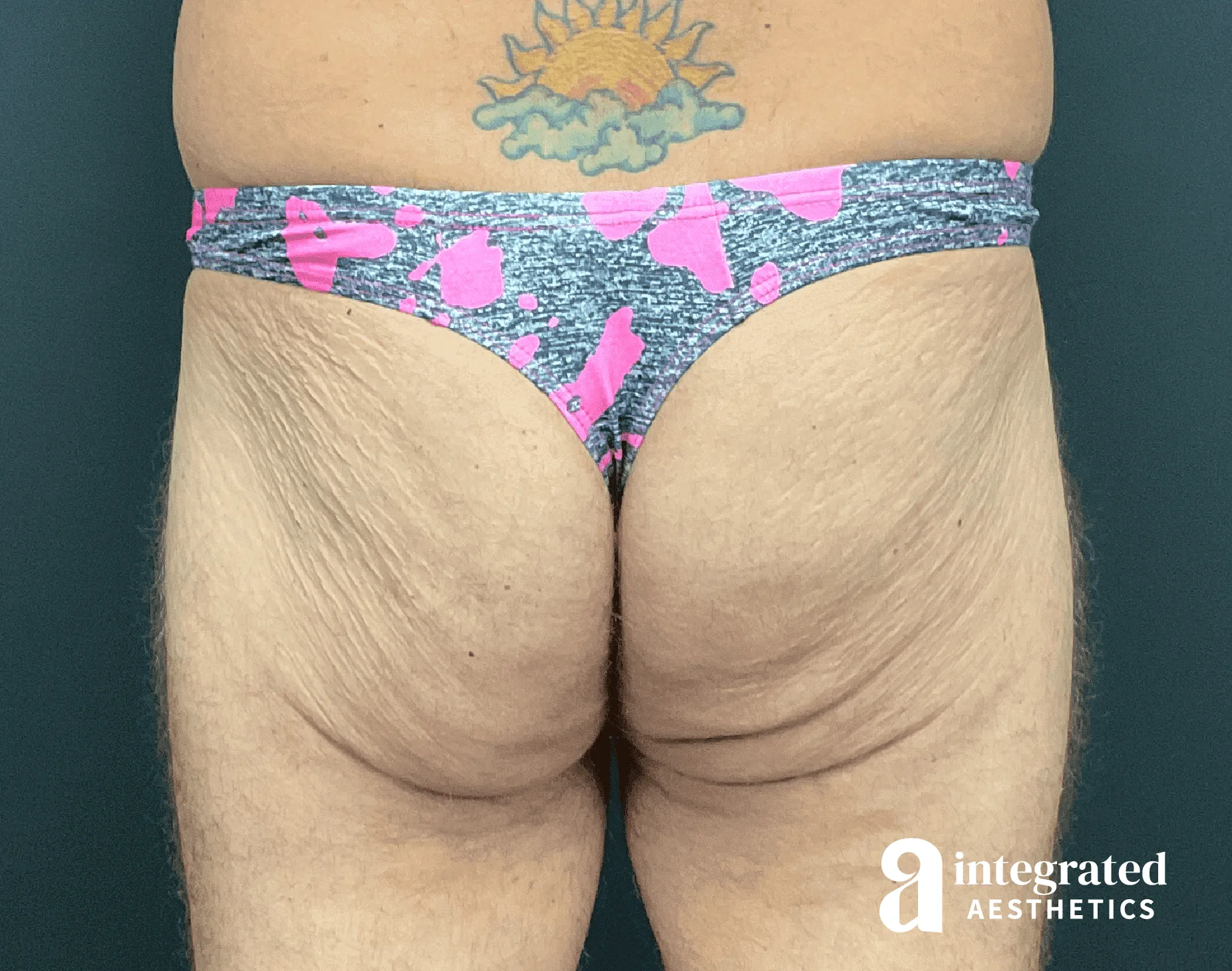 Butt Lift