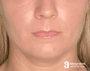 Dermal Fillers