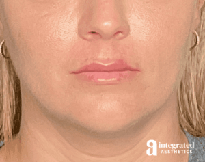 Dermal Fillers