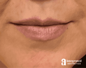 Dermal Fillers