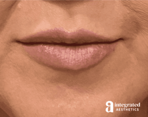 Dermal Fillers
