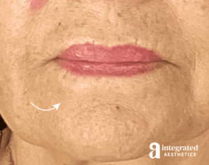 Dermal Fillers