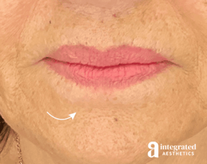 Dermal Fillers