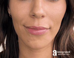 Dermal Fillers