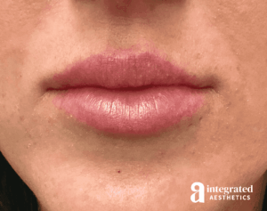 Dermal Fillers