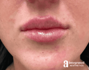 Dermal Fillers