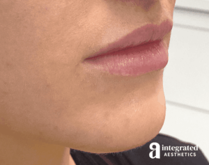 Dermal Fillers