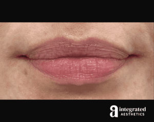 Dermal Fillers