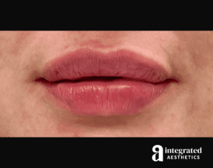 Dermal Fillers