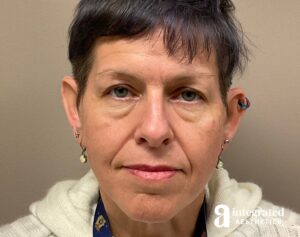Dermal Fillers