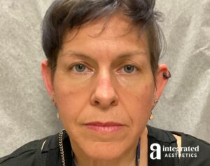 Dermal Fillers