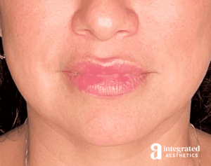 Dermal Fillers