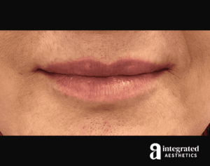 Dermal Fillers