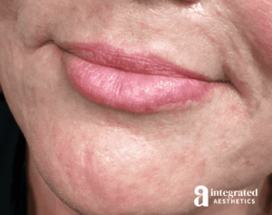 Dermal Fillers