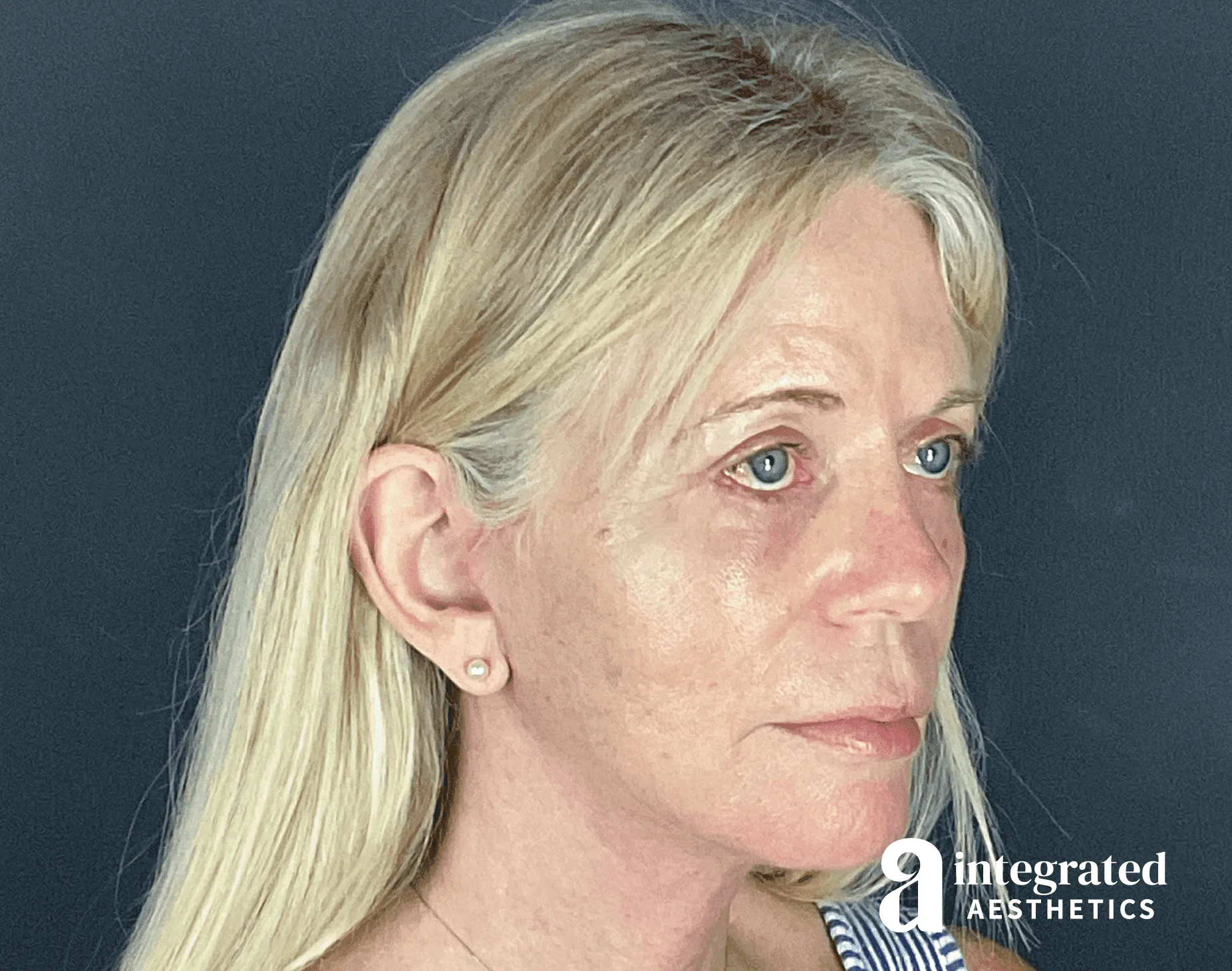 Facelift & Neck Lift